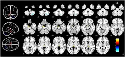 Brain entropy changes in classical trigeminal neuralgia
